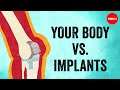 Your body vs. implants - Kaitlyn Sadtler