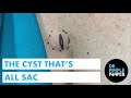 The Cyst That's All Sac