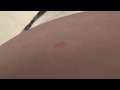 Xpreen Pro Mole Removal Part 3, 1 year later results update