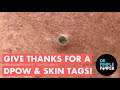 Give Thanks for a DPOW & Skin Tags!