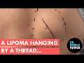 A Lipoma Hanging By A Thread