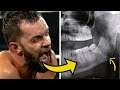 10 Ways Wrestlers Faces Were Altered Forever Because Of Wrestling