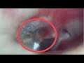 Ear Wax Removal With Endoscope Camera