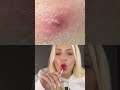 Wooooww el final😱 AMO estos videos #shorts #satisfying #pimples #reaccion #katieangel