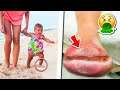Toddler Walks Barefoot On Beach, Then Parents See His Foot And Rush To The Hospital