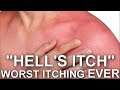 I Have Experienced "Hell's Itch" An Uncontrollable, Painful Scratching On Your Sunburned Skin!