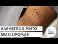 Harvesting Pinto Bean Lipomas